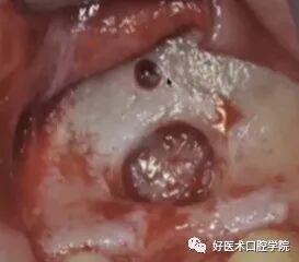 一文读懂与上颌窦提升术相关的上颌窦囊性病变！