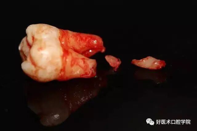 牙胶尖什么颜色早读 ｜ 几十年牙医总结临床经验，现在只需几分钟便可全部了解！_https://www.jmylbn.com_新闻资讯_第6张