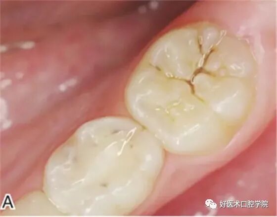 牙胶尖什么颜色早读 ｜ 几十年牙医总结临床经验，现在只需几分钟便可全部了解！_https://www.jmylbn.com_新闻资讯_第16张