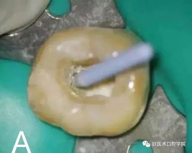 牙胶尖什么颜色早读 ｜ 几十年牙医总结临床经验，现在只需几分钟便可全部了解！_https://www.jmylbn.com_新闻资讯_第17张