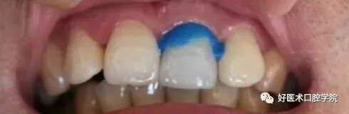 牙胶尖什么颜色早读 ｜ 几十年牙医总结临床经验，现在只需几分钟便可全部了解！_https://www.jmylbn.com_新闻资讯_第27张