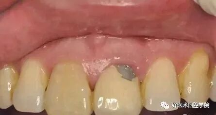 牙胶尖什么颜色早读 ｜ 几十年牙医总结临床经验，现在只需几分钟便可全部了解！_https://www.jmylbn.com_新闻资讯_第4张