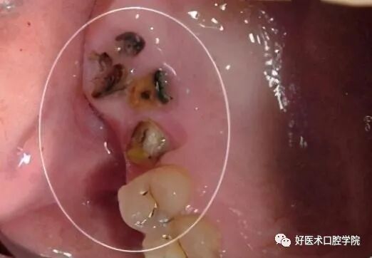 牙胶尖什么颜色早读 ｜ 几十年牙医总结临床经验，现在只需几分钟便可全部了解！_https://www.jmylbn.com_新闻资讯_第3张