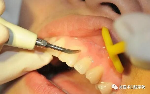 牙胶尖什么颜色早读 ｜ 几十年牙医总结临床经验，现在只需几分钟便可全部了解！_https://www.jmylbn.com_新闻资讯_第10张