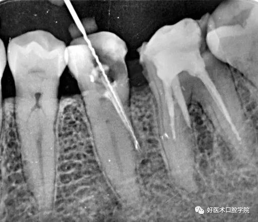 牙胶尖什么颜色早读 ｜ 几十年牙医总结临床经验，现在只需几分钟便可全部了解！_https://www.jmylbn.com_新闻资讯_第9张