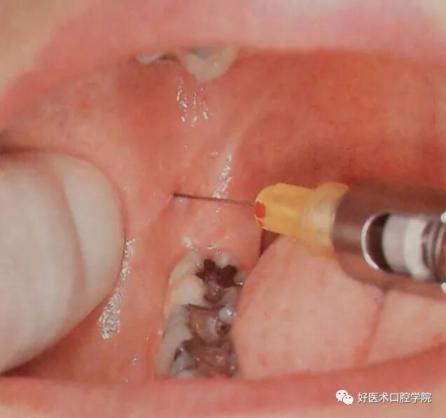 牙胶尖什么颜色早读 ｜ 几十年牙医总结临床经验，现在只需几分钟便可全部了解！_https://www.jmylbn.com_新闻资讯_第7张