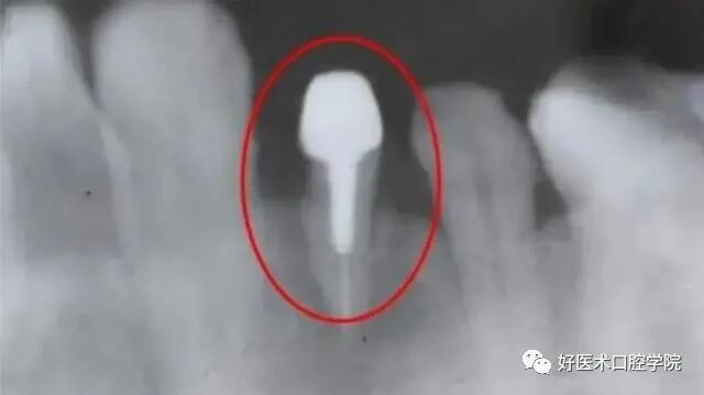 牙胶尖什么颜色早读 ｜ 几十年牙医总结临床经验，现在只需几分钟便可全部了解！_https://www.jmylbn.com_新闻资讯_第5张