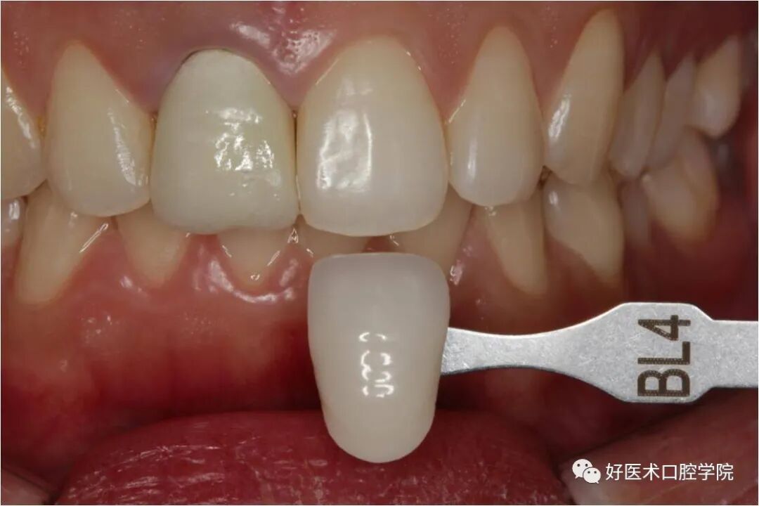牙胶尖什么颜色早读 ｜ 几十年牙医总结临床经验，现在只需几分钟便可全部了解！_https://www.jmylbn.com_新闻资讯_第26张