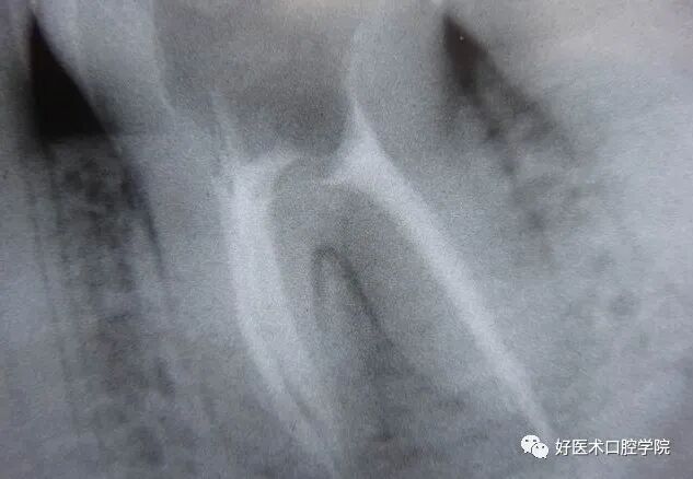 牙胶尖什么颜色早读 ｜ 几十年牙医总结临床经验，现在只需几分钟便可全部了解！_https://www.jmylbn.com_新闻资讯_第22张