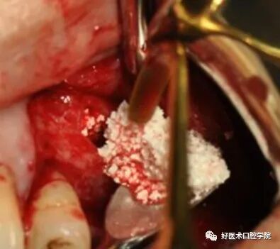 一文读懂与上颌窦提升术相关的上颌窦囊性病变！