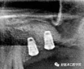 一文读懂与上颌窦提升术相关的上颌窦囊性病变！