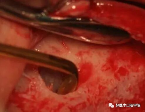 一文读懂与上颌窦提升术相关的上颌窦囊性病变！