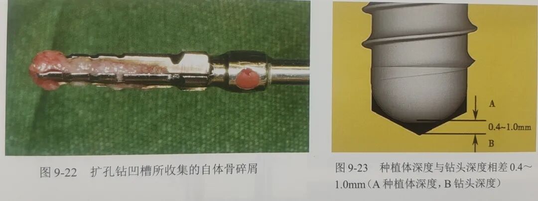 甲状腺拉钩怎么用早读 ｜ 盘点口腔种植手术器械，一文告诉你怎么使用！_https://www.jmylbn.com_新闻资讯_第22张