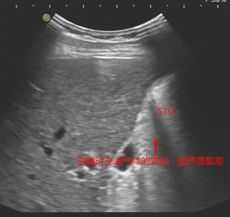 什么是超声容积探头新技术 ｜ 胃肠不好怕检查？别怕！胃肠充盈超声造影检查新方法来帮您_https://www.jmylbn.com_新闻资讯_第8张