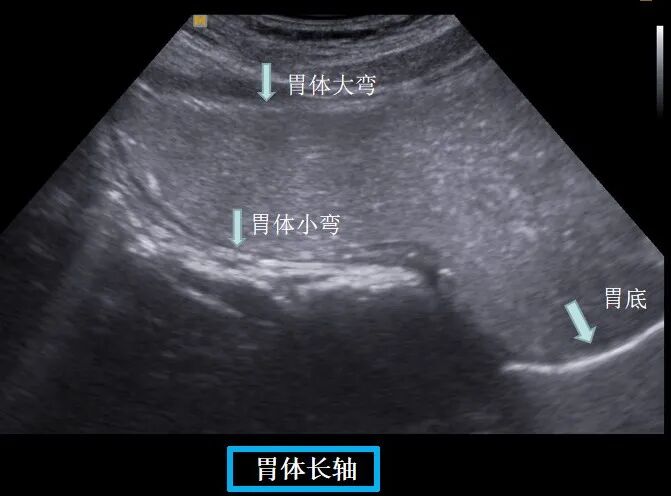 什么是超声容积探头新技术 ｜ 胃肠不好怕检查？别怕！胃肠充盈超声造影检查新方法来帮您_https://www.jmylbn.com_新闻资讯_第11张