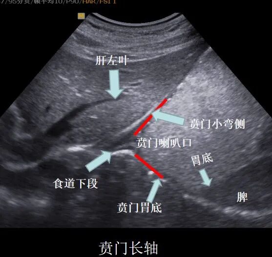什么是超声容积探头新技术 ｜ 胃肠不好怕检查？别怕！胃肠充盈超声造影检查新方法来帮您_https://www.jmylbn.com_新闻资讯_第9张