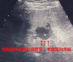 什么是超声容积探头新技术 ｜ 胃肠不好怕检查？别怕！胃肠充盈超声造影检查新方法来帮您_https://www.jmylbn.com_新闻资讯_第13张