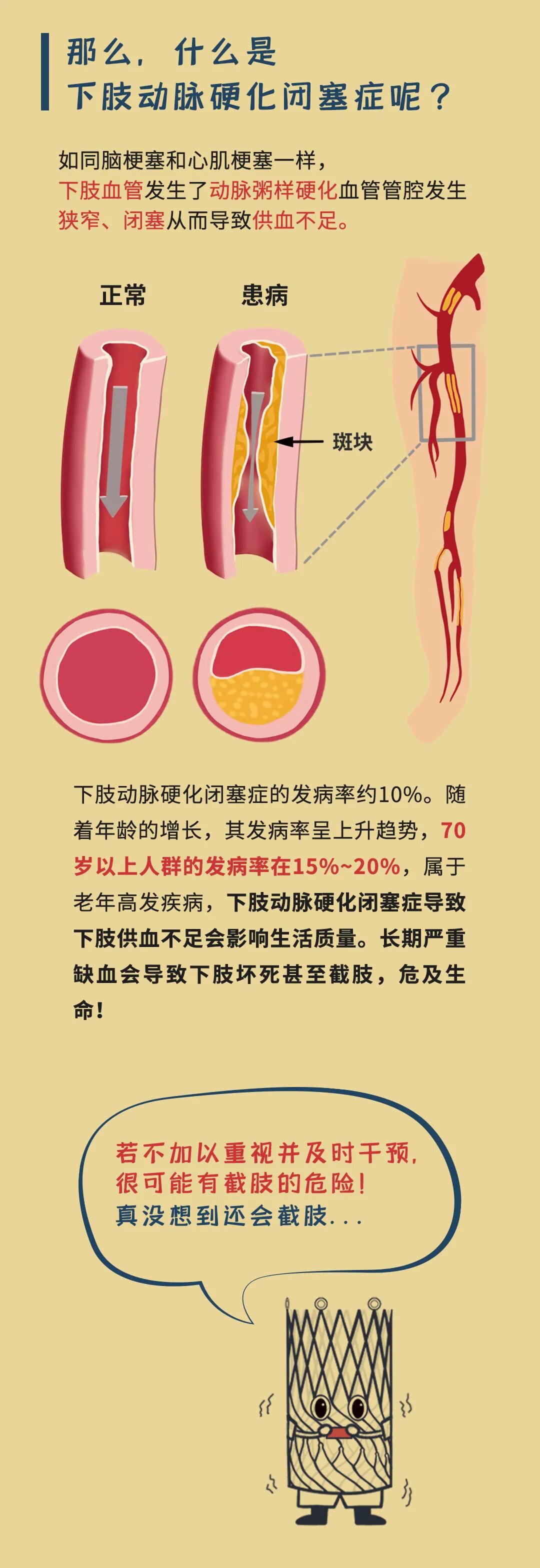 什么是外周介入外周血管疾病找介入，科学就医有新路-上海聚慕医疗器械有限公司