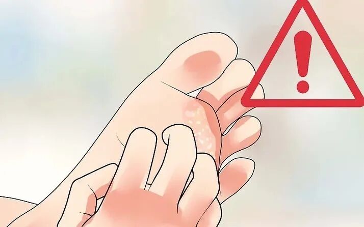 手足癣应该如何预防！