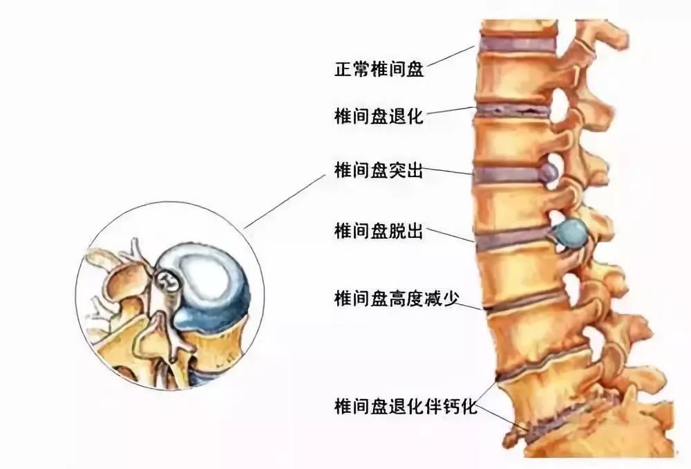 腰间盘突出自我康复疗法，简单不花钱(示例图).