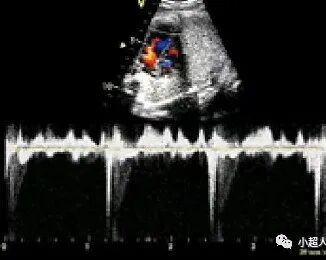 胎儿超声心电图是什么超声小视角之胎儿房室传导阻滞_https://www.jmylbn.com_新闻资讯_第7张