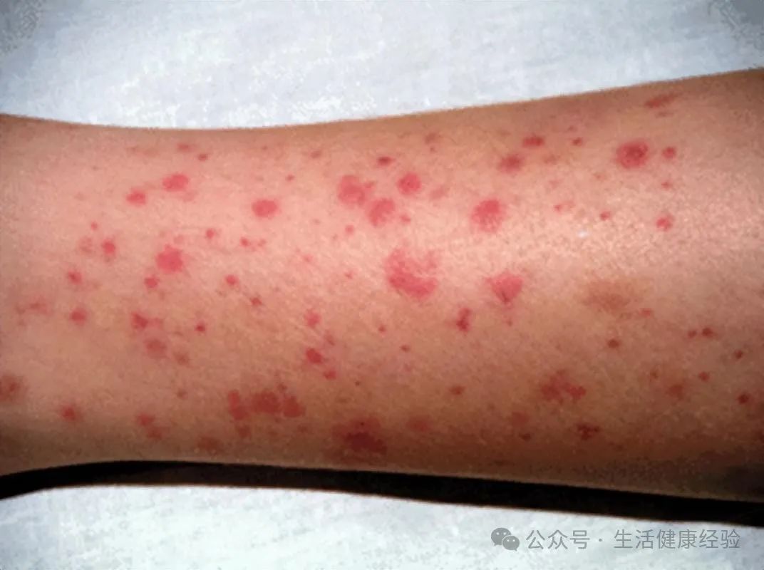 紫癜的出现可能与多种因素有关，包括血小板减少、血管炎、某些感染性疾