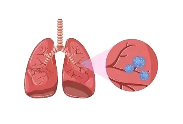 肺部结节 肺部结节