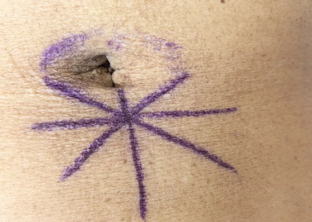 放疗怎么定位【肿瘤内科、放疗科科普】看护“纹身”，抑制肿瘤生长，教你如何保护放疗定位线_https://www.jmylbn.com_新闻资讯_第3张