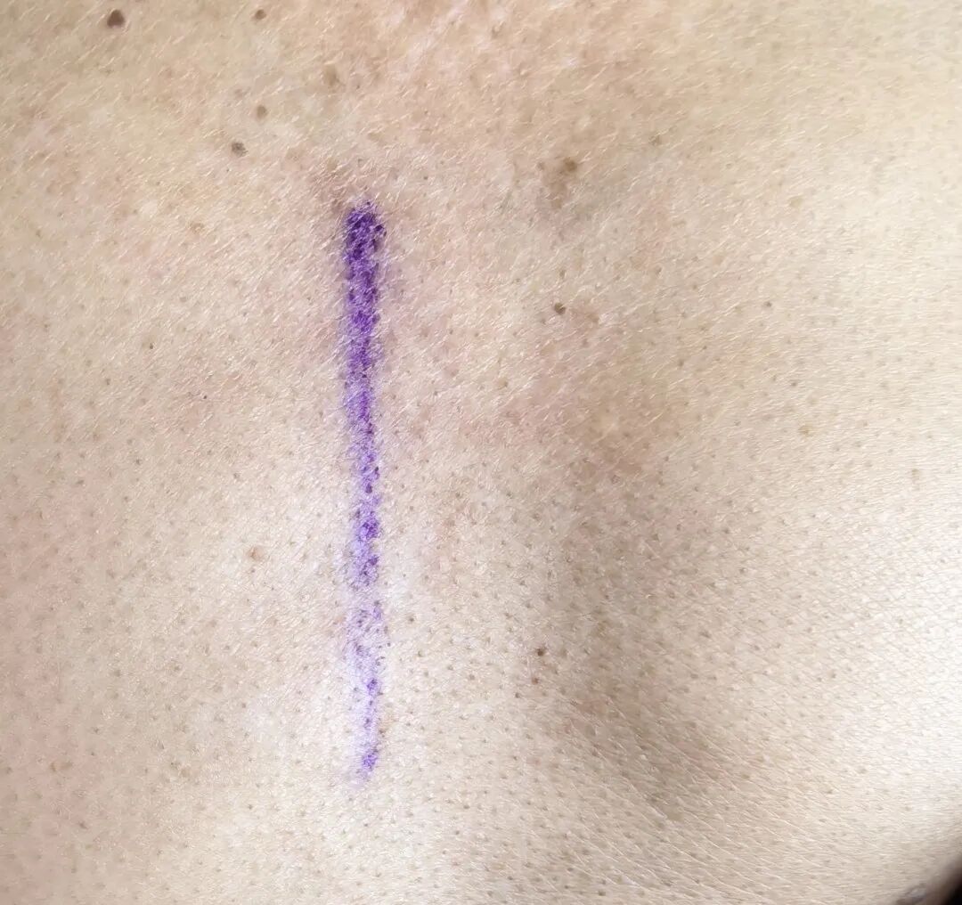 放疗怎么定位【肿瘤内科、放疗科科普】看护“纹身”，抑制肿瘤生长，教你如何保护放疗定位线_https://www.jmylbn.com_新闻资讯_第5张