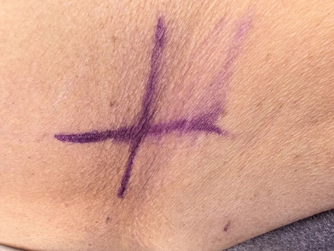 放疗怎么定位【肿瘤内科、放疗科科普】看护“纹身”，抑制肿瘤生长，教你如何保护放疗定位线_https://www.jmylbn.com_新闻资讯_第2张