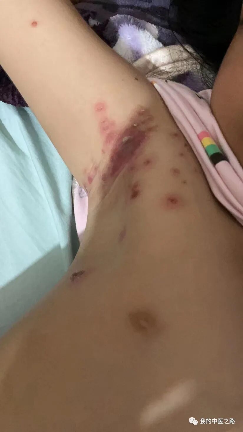 小柴胡汤合三仁汤治愈带状疱疹一例