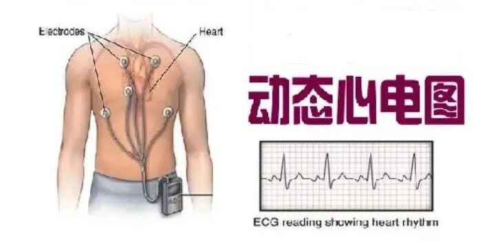 动态心电图自己怎么记录动态心电图——捕捉心脏跳动的“守护者”_https://www.jmylbn.com_新闻资讯_第3张