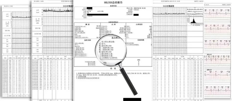 动态心电图自己怎么记录动态心电图——捕捉心脏跳动的“守护者”_https://www.jmylbn.com_新闻资讯_第4张