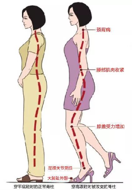 自测一下，看看你的腰突是哪个程度？