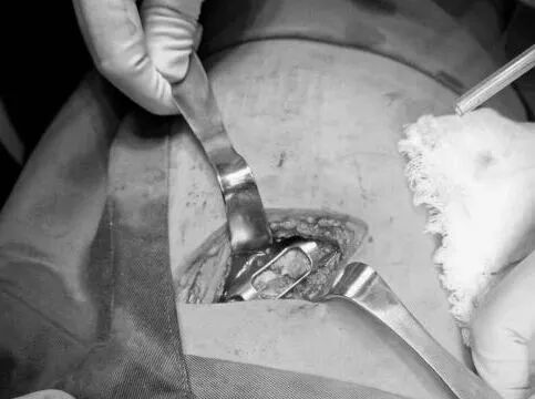 肋骨怎么记忆【科室动态】我院胸外科顺利完成记忆合金环抱器肋骨骨折切开复位内固定术_https://www.jmylbn.com_新闻资讯_第4张