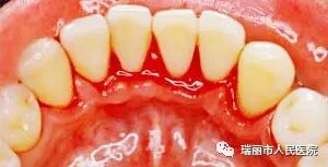 牙周治疗仪怎么做牙周牙周健康与治疗 --瑞丽市人民医院口腔科_https://www.jmylbn.com_新闻资讯_第12张