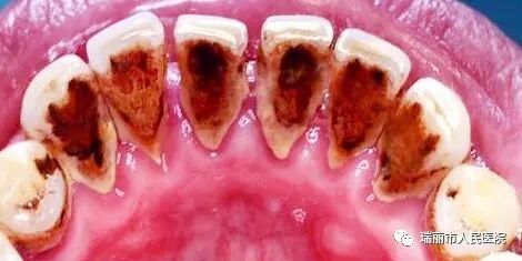 牙周治疗仪怎么做牙周牙周健康与治疗 --瑞丽市人民医院口腔科_https://www.jmylbn.com_新闻资讯_第13张