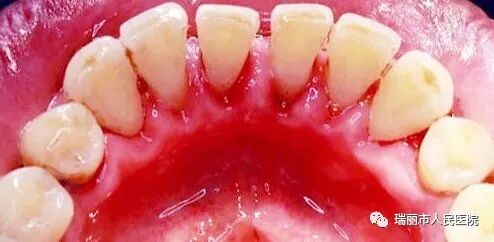 牙周治疗仪怎么做牙周牙周健康与治疗 --瑞丽市人民医院口腔科_https://www.jmylbn.com_新闻资讯_第14张