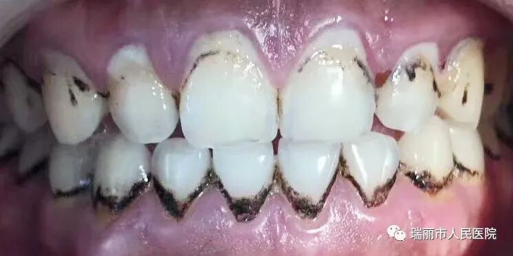 牙周治疗仪怎么做牙周牙周健康与治疗 --瑞丽市人民医院口腔科_https://www.jmylbn.com_新闻资讯_第9张