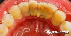 牙周治疗仪怎么做牙周牙周健康与治疗 --瑞丽市人民医院口腔科_https://www.jmylbn.com_新闻资讯_第11张