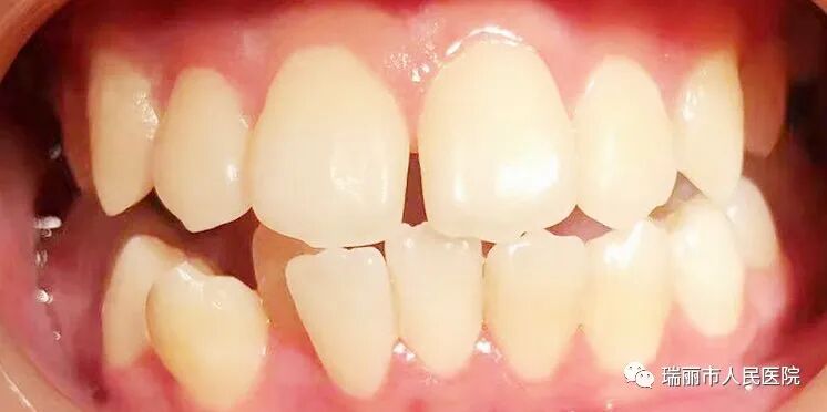 牙周治疗仪怎么做牙周牙周健康与治疗 --瑞丽市人民医院口腔科_https://www.jmylbn.com_新闻资讯_第8张