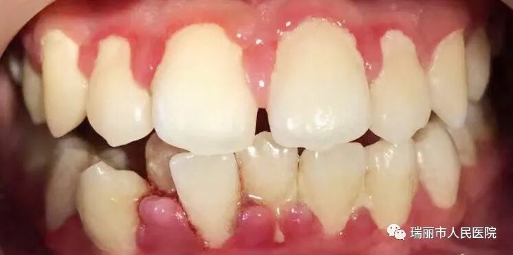 牙周治疗仪怎么做牙周牙周健康与治疗 --瑞丽市人民医院口腔科_https://www.jmylbn.com_新闻资讯_第7张