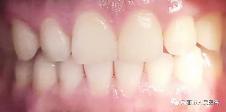 牙周治疗仪怎么做牙周牙周健康与治疗 --瑞丽市人民医院口腔科_https://www.jmylbn.com_新闻资讯_第10张