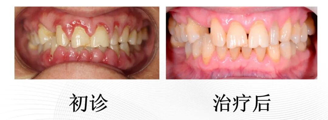 ems洁牙尖怎么分无痛的超声“洗牙”！哈医大四院口腔科引进EMS全功能牙周清洗机给牙齿做SPA_https://www.jmylbn.com_新闻资讯_第4张