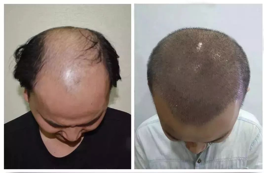 29歲小夥竟脫髮到禿頂！他做了這件事後變成了... 健康 第17張