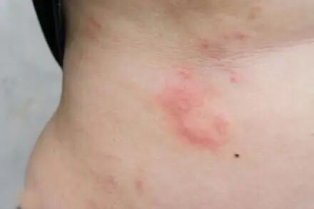 螨虫病的症状图片图库_被螨虫咬的症状图片_螨虫疹图片和症状图片