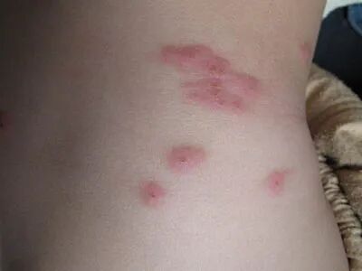 被螨虫咬的症状图片_螨虫疹图片和症状图片_螨虫病的症状图片图库