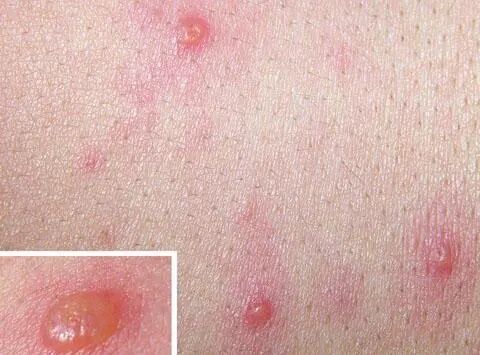 螨虫病的症状图片图库_螨虫疹图片和症状图片_被螨虫咬的症状图片