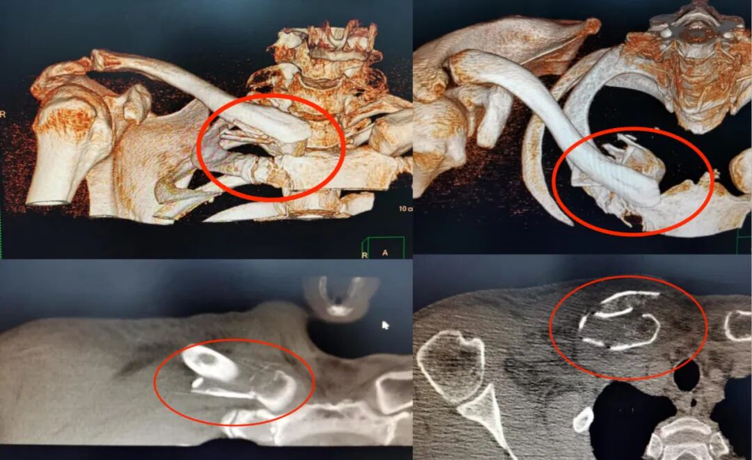 Illustration 3 for 锁骨近端复杂骨折不再愁！DR CT X片精准解读，cc胸锁钩钢板低风险手术新突破，实现快速康复！