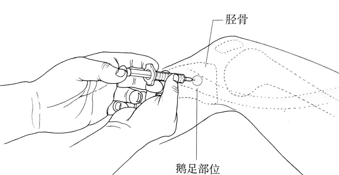但覆盖深部的鹅足腱膜较厚,因此,穿刺针要深达胫骨.